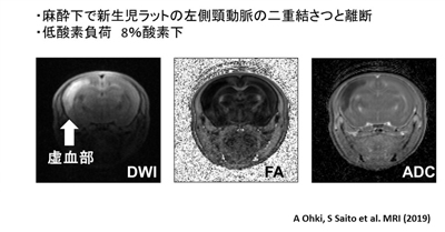 胎生期低酸素虚血性脳症