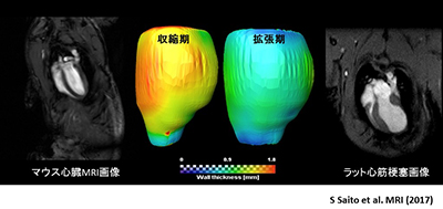 心筋壁厚マッピングと心筋梗塞モデル
